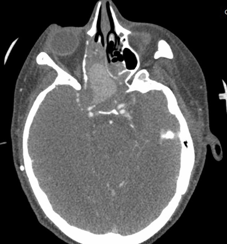 Figure 10 Axial view of the head CT with contrast showing a pseudoaneurysm of the cavernous portion of the right internal carotid artery protruding into the ethmoidal sinus.