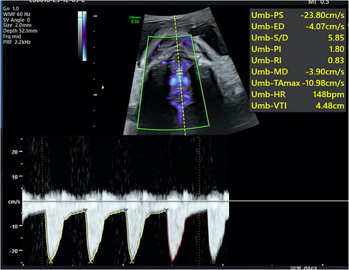 Figure 2. The waveform recorded via basilar artery Doppler was below the baseline, away from the transducer, and consistent with the caudocephalic orientation. The angle at which the Doppler ultrasound probe was placed was approximately 0° at the visualized segment of the basilar artery.