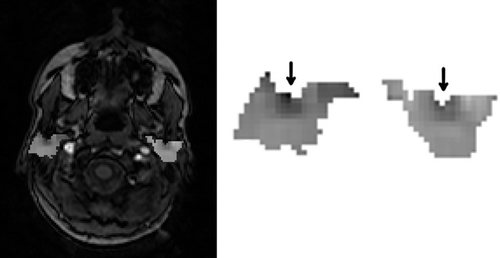Figure 2. An example 2D image map slice. At left: a temporallyaveraged T1 -weighted image with the difference of changes in slope map overlaid on the parotids; at right: enlarged parotid maps. In the latter, voxels showing no stimulatory response are midtone. Those that responded positively (negatively) are brighter (darker).
