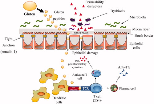 Figure 1. Mechanisms involved in the pathogenesis of coeliac disease. The figure shows the intestinal cells maintained in mutual contact by tight junctions. Luminal and early mucosal events able to alter intestinal barrier (e.g. mucine thinning) and/or to directly damage the intestinal mucosa (such as drugs, infections, changes in the microbiota) may facilitate macromolecules including gluten peptides to cross the leaking mucosa. Gluten not fully digested in the lamina propria is captured by tissue transglutaminase and deamidated. The more sticky fragments are bound to DQ2 or DQ8 antigen-presenting cells leading to the release of cytokines and activation of CD4+ T cells and, in turn, to tissue damage. INF: interferon; TCR: T cell receptor.