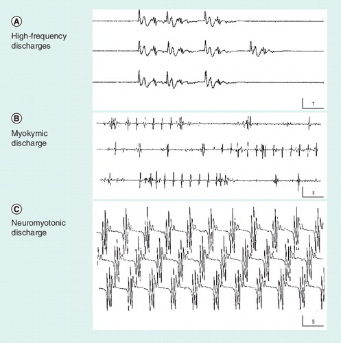 Figure 1. Various types of spontaneous activity recorded with needle electromyography as an expression of axonal hyperexcitability.(A) High-frequency discharge. It usually results from an ectopic focus generating activity of neighboring hyperexcitable muscle fibers. (B) Myokymic discharge. Action potentials of a relatively simple shape, either isolated or repeating in groups at a stable frequency. (C) Neuromyotonic discharge. Complex action potentials that repeat with no variation, sometimes at a very high frequency. †Calibration is 10 ms × 0.2 mV.‡Calibration is 50 ms × 0.5 mV.§Calibration is 20 ms × 0.1 mV.