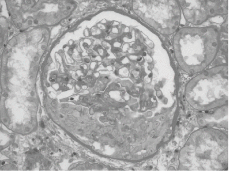 Figure 1. Cellular crescent in PAS (×400).