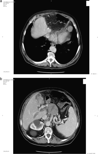 Figure 1.  (a) Pericardial fat node: baseline CT-scan. (b) Celiac node: baseline CT-scan.