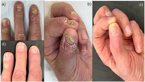 Figure 1. (a,b): Oedema, erythema, crusts and coalescent pustules of the nail fold and fingertip, with concomitant onychodystrophy. (c,d): Complete resolution of the lesions, including nails.
