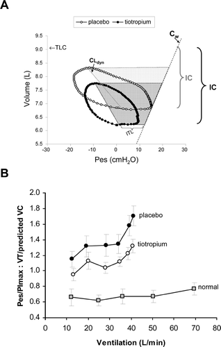 Figure 7 (A) Campbell diagrams are shown at a standardized time during constant-load exercise for a patient with severe COPD (FEV1 = 29 % predicted). After tiotropium compared with placebo, there were decreases in the inspiratory threshold load (ITL), the elastic work of breathing (shaded areas), and the resistive work of breathing (area within volume-Pes loops). Abbreviations: CLdyn = dynamic compliance, Cw = chest wall compliance, IC = inspiratory capacity, Pes = esophageal pressure. (B) The relationship between respiratory effort (Pes/PImax) and tidal volume displacement [VT standardized as a fraction of predicted vital capacity (VC)], an index of neuromechanical coupling, is shown during constant work rate exercise after tiotropium and placebo in patients with moderate to severe COPD (data from reference 56). Data from a group of age-matched healthy subjects during exercise is also shown (data from reference 50). Compared with placebo, tiotropium enhanced neuromechanical coupling throughout exercise in COPD. Values are means ± SEM.