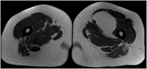 Figure 1. Axial section of MRI of lipoma.