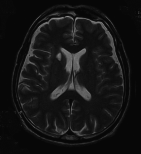 Figure 2.  T2-weighted magnetic resonance image. Old lacunar infarction is seen in the right caudate nucleus.