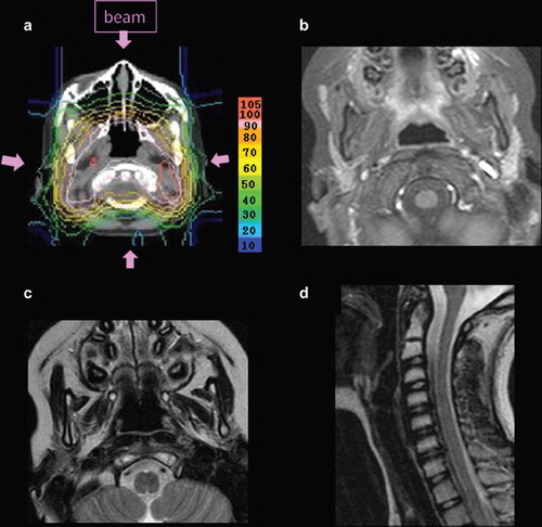 Figure 1. The dose distribution and the MRIs after proton therapy: Proton beams were delivered via 3 ports (a) and the bilateral parotid glands (b), mandibular ramus (c), and cervical spine (d) in the treatment field showed retardation.