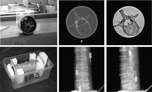 Figure 1. The spine fastened in a plastic tube (top left); the final phantom with fiducial markers attached to the outside of the tube (bottom left); CT image (top center); MR image (top right); and AP (bottom center) and lateral (bottom right) X-ray images of the phantom.