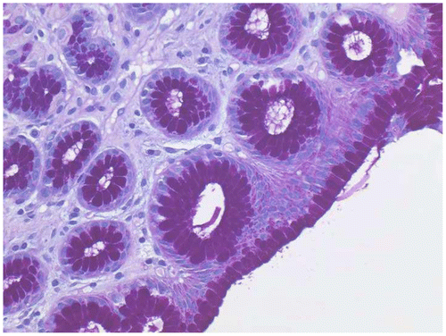 Figure 5 Stomach biopsy stained with AB–PAS, ×40. Mucin is pink–red.