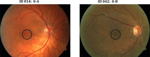 Figure 1 Examples of fundus photos from two study eyes graded as 0-A (left; no minimal macular changes) and 0-B (right; with minimal macular changes). The black circle indicates the region in the macula where fundus retinal changes were observed.