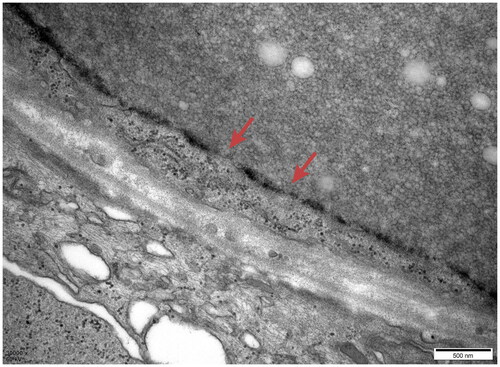 Figure 10. Electron microscopy: The basement membrane showed insect eroding and tear-like changes.