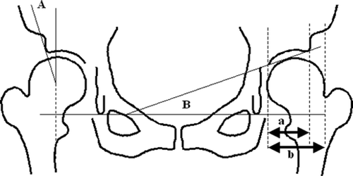 Figure 2. Radiographic parameters. A: CE angle; B: ace-tabular roof angle. Acetabular head index (AHI) = a/b × 100.