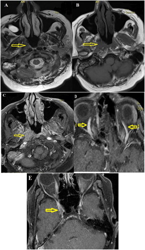 Figure 3. Brain MRI with IV gadolinium injection. (A and B) In the T1- and T2-weighted axial images without contrast at the level of the nasopharynx, minor isosignal asymmetry was present in the nasopharynx (indicated by arrows). (C) In the axial fat-saturated T1-weighted post-gadolinium injection images, evidence of asymmetry of the right lateral wall of the nasopharynx compared to the left wall (indicated by an arrow) with enhancement was observed. (D) In the evaluation of other areas, evidence of prominent right-sided superior ophthalmic vein (indicated by arrow number 1 compared to arrow number 2) with (E) involvement of a small part of the right side of the cavernous sinus (indicated by arrow) was observed. No evidence of invasion into the nasal cavity, paranasal sinuses, or orbit was observed.