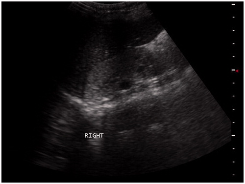 Figure 2. Ultrasound scan reveals small right kidney with hyperechogenic parenchyma and loss of corticomedullary differentiation.