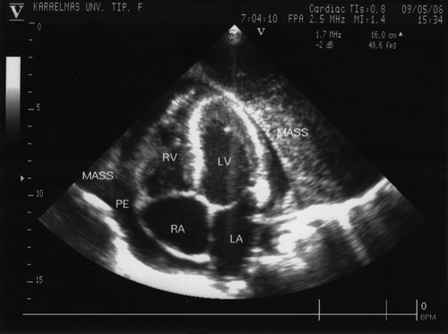 Figure 1.  Transthoracic echocardiographic view of the heart. Minimal pericardial effusion and a large mediastinal mass surrounding the heart is seen in the apical 4-chamber view. LV: Left ventricle, RV: Right ventricle, LA: Left atrium, RA: Right atrium
