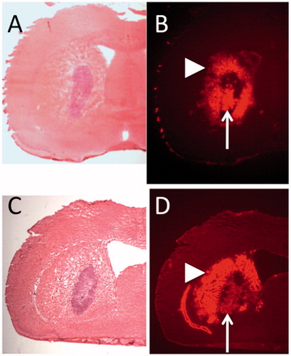 Figure 1. Seven days after tumor implantation, convection-enhanced delivery of PEGylated liposomal doxorubicin was performed into tumor of 9L isografted intracranial tumor model. Hematoxylin and Eosin (H&E) staining of representative two rat brain sections show the tumor formation (A, C). Fluorescent detection of the doxorubicin in same sections revealed robust distribution of PLD in the tumor mass and surrounding tumor margin (B, D). Note the intra-tumoral distribution (arrow) and extra-tumoral distribution (arrowhead).
