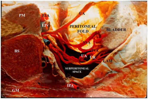 Figure 2. Parasagittal cut on the right female pelvis. An embalmed corpse, the peritoneal sheet of the parametrium was transilluminated. Notice that the parametrium in a straight space has plenty of arteries, veins, and the ureter.