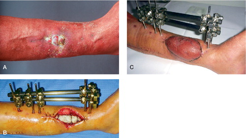 Figure 1. Condition of soft tissue in case 4:chronic wound surrounded by scarred soft tissues on admission (A).Soft tissue defect after debridement and prior to coverage with a serratus anterior free flap.The cement spacer inlay has been implanted after a thorough bone debridement and stabilized with wires to the bony stumps.Tibial shaft stabilization is obtained with an external fixator (B).Complete skin graft healing over the free flap prior to removal of the cement spacer and bone reconstruction with iliac crest bone (C).