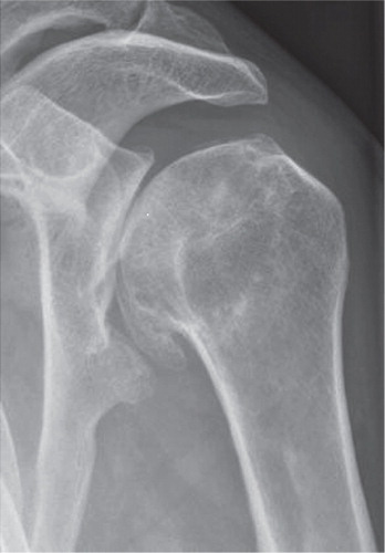 Figure 1. Pathological changes associated with glenohumeral osteoarthritis. Flattening of the humeral head; glenoid wear; posterior subluxation; and osteophytes around the glenoid and the humeral head.
