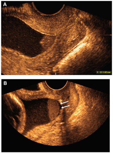 Figure 2. Transvaginal ultrasound scan demonstrating an intra-amniotic sludge above the internal cervical os (A and B - sludge of different sizes).