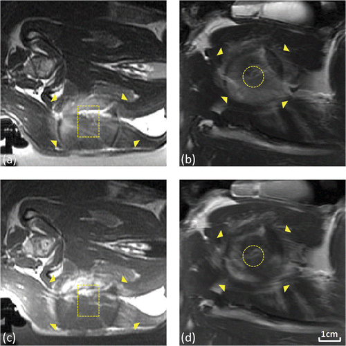 Figure 5. Tissue damage observed using T2-weighted and contrast-enhanced T1-weighted imaging following thermal coagulation in rabbit thigh. (a,b) T2-weighted axial (a) and coronal (b) images through the center of the heated region. (c,d) Corresponding contrast-enhanced T1-weighted axial (c) and coronal (d) images from the same experiment. 80 mm field of view, target regions (outlined) and thermal damage boundaries (arrows) shown.