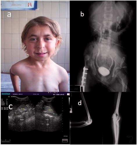 Figure 1. Clinical and radiological features of the index patient. (a) Facial appearance of the patient, (b) voiding urethrocystography reveals bilateral vesicoureteral reflux. Congenital dysplasia of the right hip (after surgery) (c) kidney ultrasound scan reveals bilateral hypodysplasia and (d) X-ray shows deformity of the proximal radius.