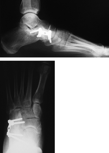 Figure 2. The same patient after calcaneo-cuboid distraction arthrodesis.