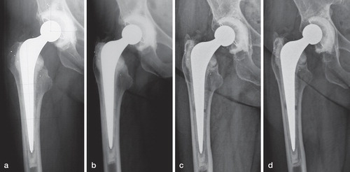 Figure 1. Patient 3 with a complete circumferential cement mantle fracture. a) 6 weeks post-operative radiograph: No abnormalities were seen. b) 2 year follow-up radiograph: A cement mantle fracture in Gruen zone IV is noted. c) 5 year follow-up radiograph: A complete circumferential cement mantle fracture is present. d) 10 year follow-up radiograph: Increased separation of the cement mantle. Between the 2 and 3 year RSA examination, a sudden and substantial increase in subsidence and retroversion of the stem was measured. At 12 year follow-up, subsidence was 9.7 mm and retroversion 11°.