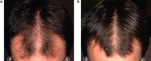 Figure 4. Photographic evaluation of treatment response to finasteride. (A) Pre-treatment; (B) post-treatment.