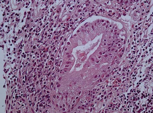 Figure 2. The lamina propia’s inflammatory cells consist of eosinophils, lymphocytes, and plasma cells with focal cryptitis (H–E × 400).