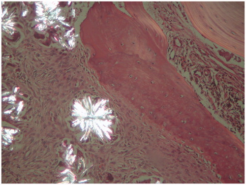Figure 2. Double light refracting crystals under a polarized microscope (H&E, ×100).