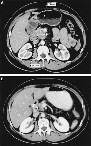 Figure 1.  (A) An abdominal CT scan performed before chemotherapy demonstrating a 28×24 mm tumour in the head of pancreas. (B) Abdominal CT scan after 3 months of chemotherapy showing a markedly decreased tumour.