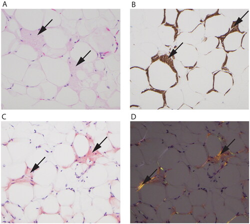 Figure 2. Fat tissue with amyloid deposition (arrows in all panels). (A) Hematoxylin eosin stain showing eosinophilic amorphous material. (B) Immunohistochemistry shows a positive reaction for transthyretin in the depositions. (C) Congo red stain is positive with orange color in the depositions and shows (D) green and orange birefringence under polarized light.
