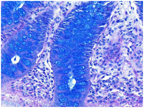 Figure 7 Rectal biopsy stained with AB-PAS, ×40. Mucin is stained blue. There is little neutral mucin present, so the mucin is more of a sky blue compared to color found in the duodenum.