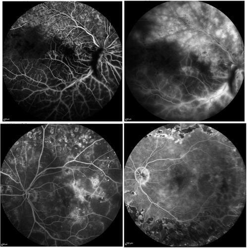 Figure 6 Panels of retinal angiography in central venous thrombosis with ischemic-edema and chorioretinal laser treatment.