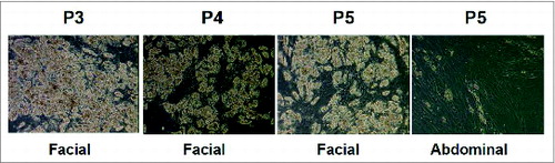 Figure 2. Facial preadipocytes retain their ability to differentiate through later subpassages than abdominal preadipocytes. Human facial and abdominal preadipocytes at the indicated subpassages were induced to differentiate by CDR. Images of the cells were taken on day 14 after plating. The pictures are representative of 3 individual experiments. CDR, control differentiation media + 10 μM rosiglitazone; P, passage number.