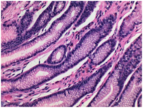 Figure 1 Stomach biopsy stained with Gill’s B hematoxylin and eosin–phloxine, ×40. Mucin is unstained.