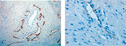 Figure 1. Low-power (A) and high-power (B) photomicrographs showing LYVE-1+ endothelial cells lining lymphatic vessels in the arthroplasty pseudocapsule. (Immunoperoxidase; 100× and 200× magnification).