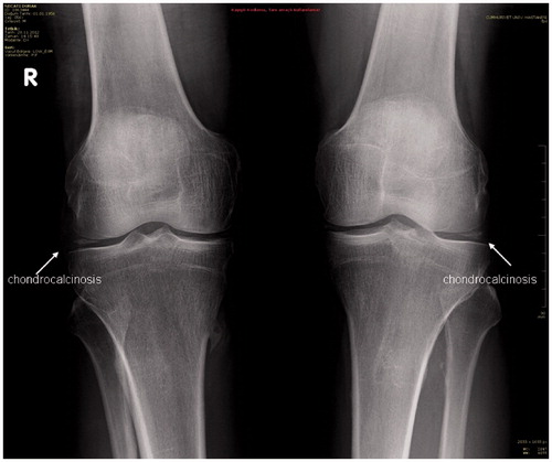 Figure 1. Chondrocalcinosis in X-ray of the patient’s knees.