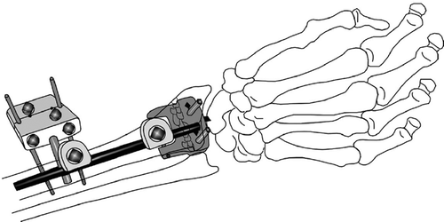 Figure 1. The Hoffman II compact non-bridging external fixator.