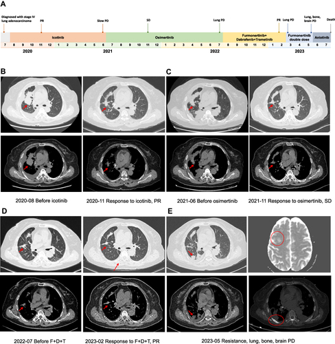 Figure 1 Schematic of treatment history of the patient. (A) The timeline of treatment (red arrow indicates the primary tumor and red circles indicate metastatic tumors). (B–E) Chest CT images and brain MRI throughout the disease course.