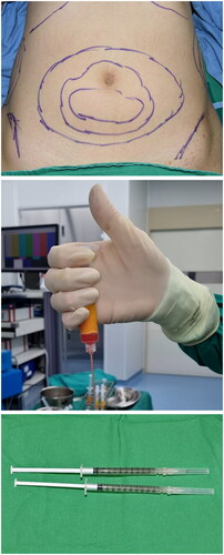 Figure 1. (A) Preoperative design for tumescent injection and fat harvesting. (B) The serum is removed from the centrifuged fat, (C) creating the desired quantity (approximately 2 cc) of the stromal vascular fraction.