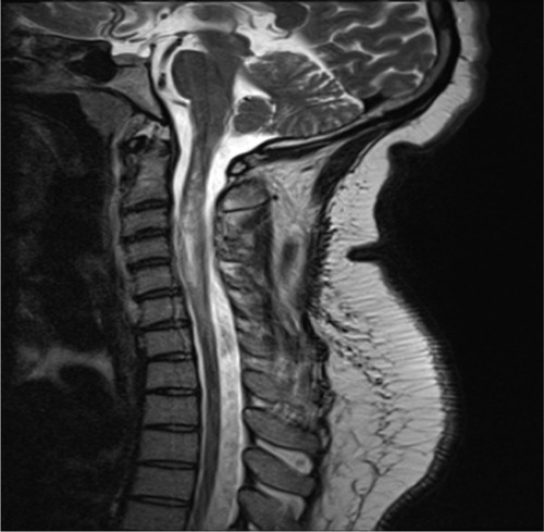 Figure 3 A sagital T2-weighted MRI of the spinal cord in a NMO patient showed hyperintense signal and swelling of several cervical and thoracic cord levels. The finding was consistent with acute myelitis.