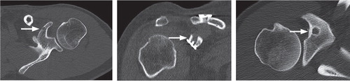 Postoperative computed tomography scans displaying the position of the coracoid bone tunnel (marked by a white arrow) in 3 patients. A. A malpositioned medial tunnel breaching the medial cortex of the coracoid. B. A coronal plane view of a laterally placed bone tunnel. C. A transverse plane view of a laterally placed tunnel.