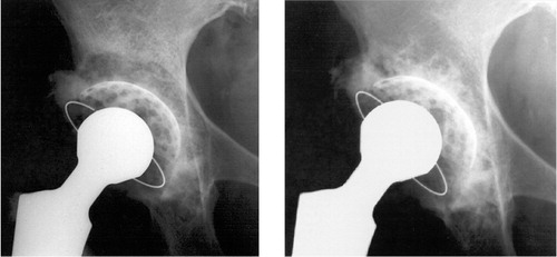 Figure 9. Radiographs of acetabular reconstruction using impaction bone grafting with a mesh covering the graft; at the right the incorporation of the graft can be seen at 16 years of follow-up
