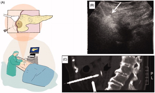 Figure 4. Microwave Ablation: A) Schematization of the MWA guided with the percutaneous. approach; B) US-image guided MWA (white arrow indicates the antenna); C) Sagittal CT view in a patient with internal/external biliary drainage (black arrow) showing the MWA antenna (white arrow) deployed a few millimetres away from the drain. Reprinted from [Citation65] Copyright 2018, with the permission of Elsevier.