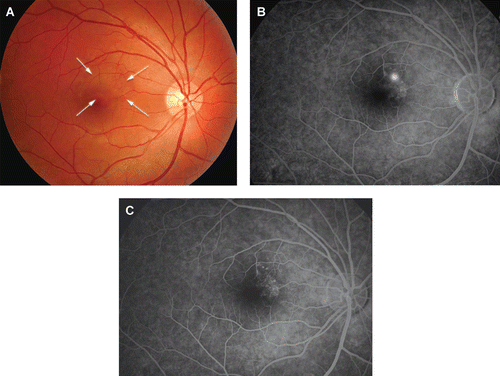 FIGURE 1  (A) At presentation, funduscopic examination of right eye shows evidence of an area of indistinct serous elevation with superiotemporal yellowish pigmentation. (Arrows delineate the limits of serous retinal detachment.) (B) Midphase fluorescein angiography (FA) shows progressive enlargement of a focal leakage point superonasal to the fovea and associated retinal pigment epithelial changes. (C) Four weeks after stopping the latanoprost therapy, FA showing resolution of leakage.