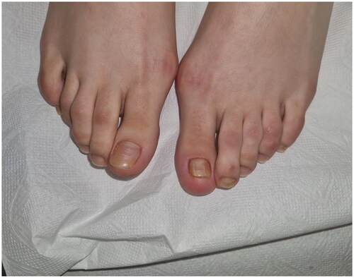 Figure 4. The clinical appearance of the nails 5 months after discontinuation of the dexpanthenol treatment.