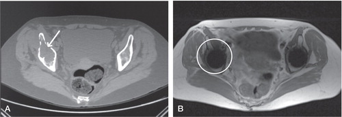 Figure 4. Comparison of the CT image (A) and the MARS MRI image (B) used to evaluate osteolysis in the same patient illustrates the comparative difficulties in identifying acetabular anatomy on MRI images, which are clear on the corresponding CT image. There is an absence of signal on MRI in this region. Coupled with the inferior bony distinction on MRI, this has prevented the identification of osteolytic changes—which are clear on CT (see arrow).